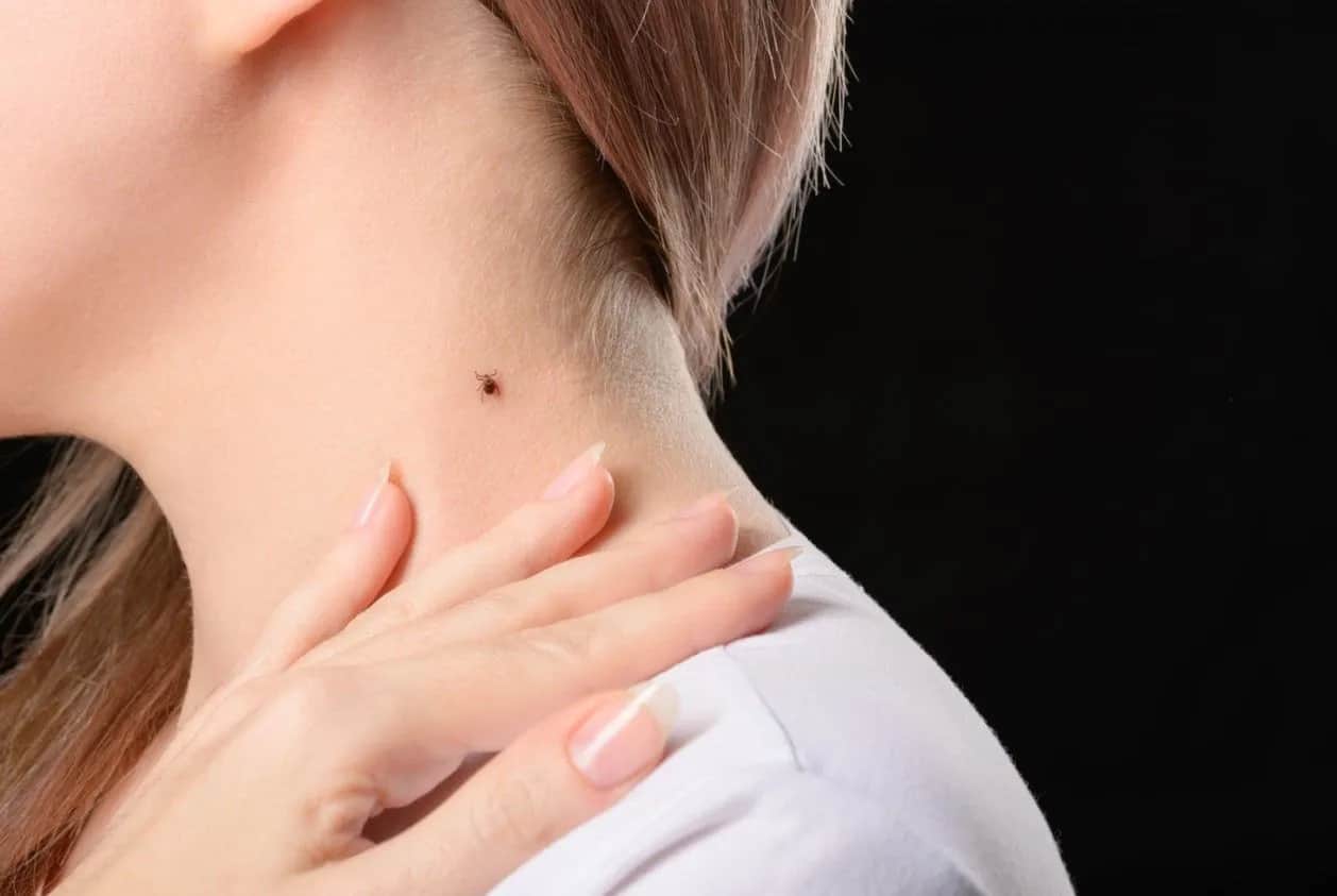 Jak rozpoznać kleszcza na skórze? Odróżnij go od pieprzyka!