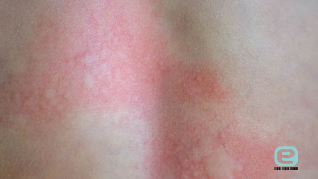 Ugryzienie kleszcza: objawy, rumień, KZM kiedy do lekarza?